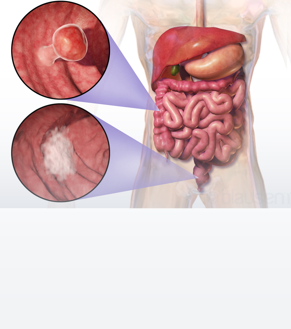 https://irepute.co.in/thangam-care/wp-content/uploads/2023/10/Causes-of-Colorectal-Cancer-1.jpg