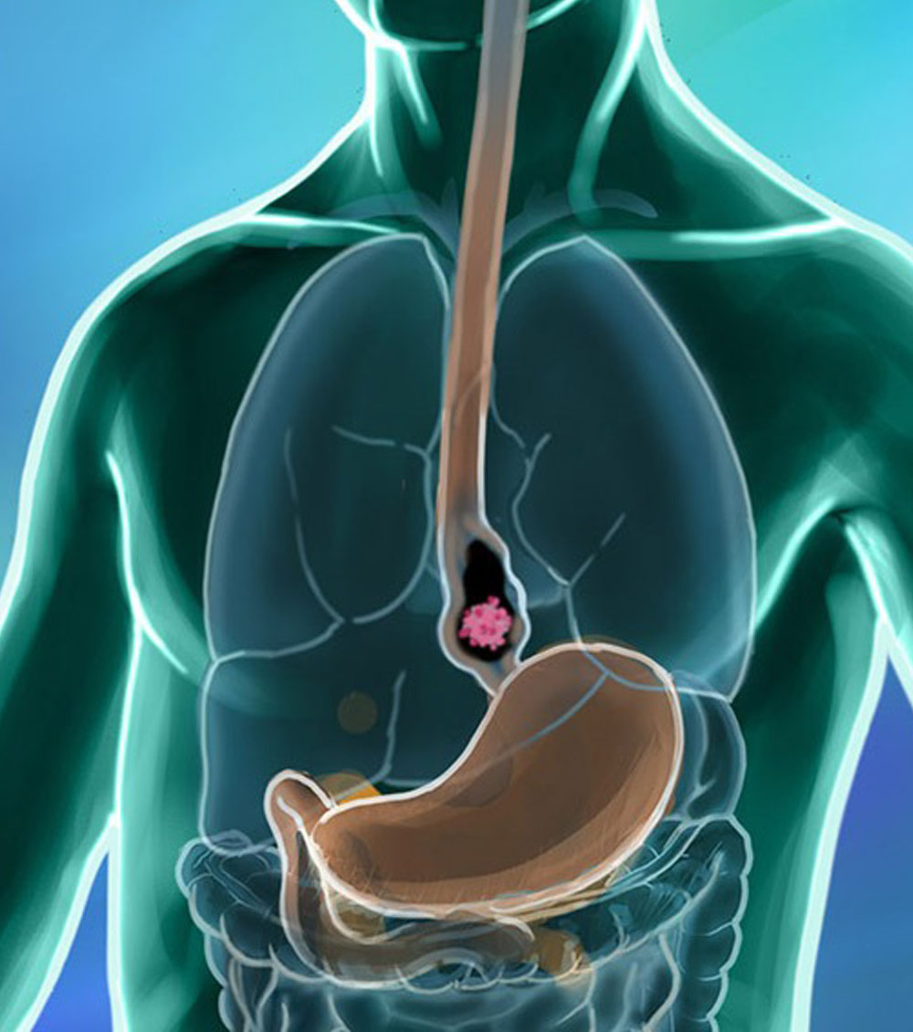 https://irepute.co.in/thangam-care/wp-content/uploads/2023/10/Esophagus-Cancer-Treatment.jpg