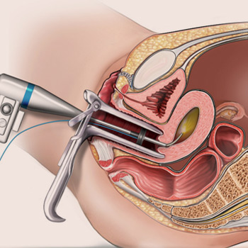 https://irepute.co.in/thangam-care/wp-content/uploads/2023/10/Hysteroscopy-1.jpg