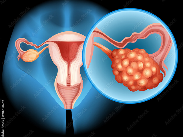 https://irepute.co.in/thangam-care/wp-content/uploads/2023/10/Ovarian-Cancer.jpg