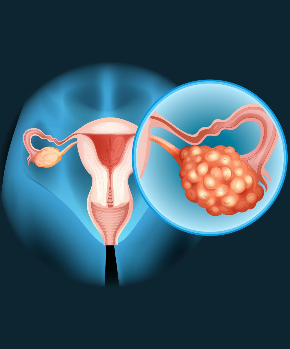 https://irepute.co.in/thangam-care/wp-content/uploads/2023/10/Treatment-for-Ovarian-Cancer.jpg