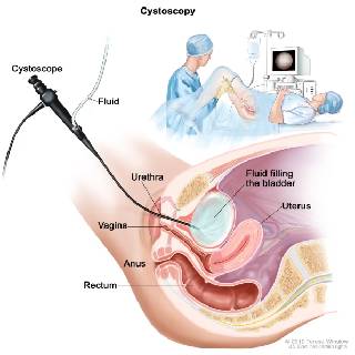 https://irepute.co.in/thangam-care/wp-content/uploads/2023/10/cystoscopy-1.jpg