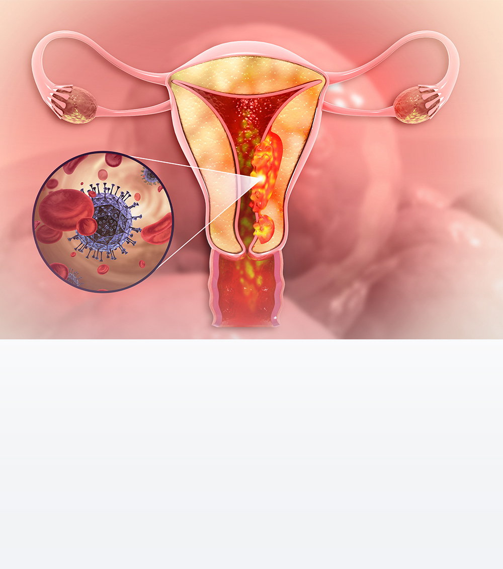 https://irepute.co.in/thangam-care/wp-content/uploads/2023/11/Causes-of-Cervix-Cancer.jpg