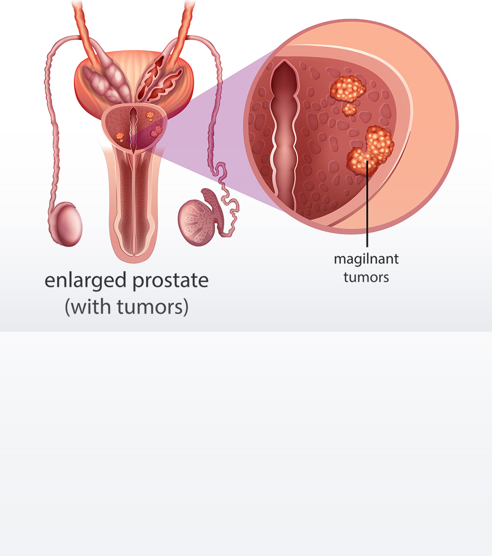 https://irepute.co.in/thangam-care/wp-content/uploads/2023/11/Causes-of-Prostate-Cancer.jpg