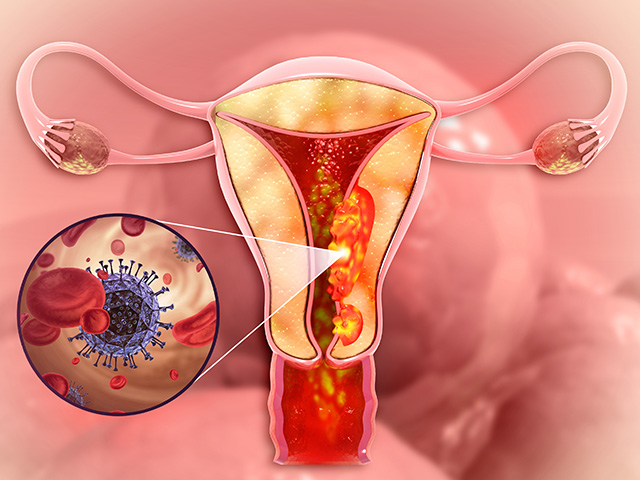 https://irepute.co.in/thangam-care/wp-content/uploads/2023/11/Endometrial-Cancer-1.jpg