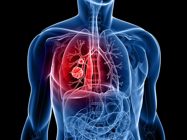 https://irepute.co.in/thangam-care/wp-content/uploads/2023/11/Lung-Cancer-1.jpg