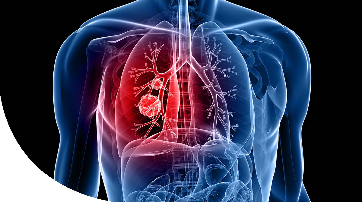 https://irepute.co.in/thangam-care/wp-content/uploads/2023/11/Lung-Cancer.jpg
