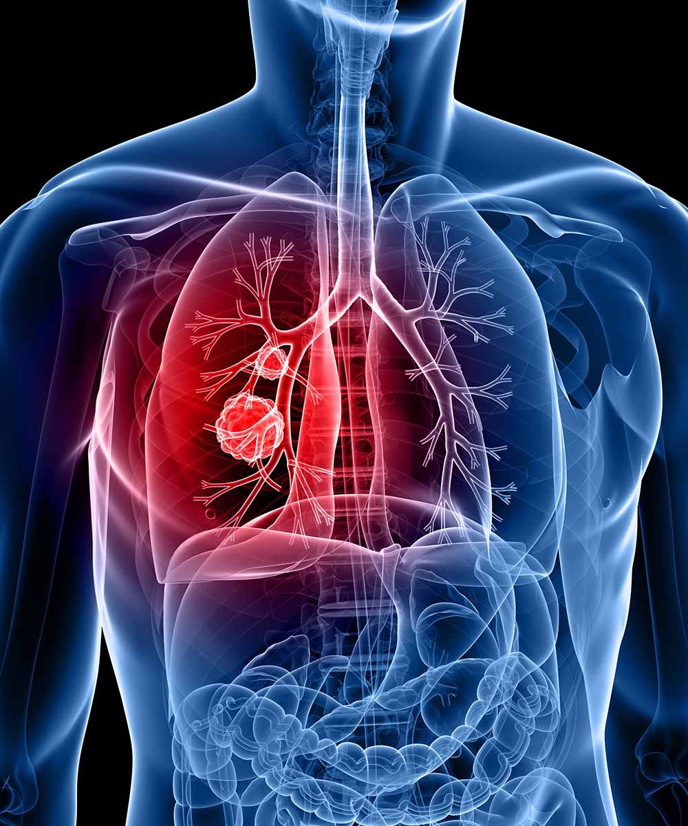 https://irepute.co.in/thangam-care/wp-content/uploads/2023/11/Treatment-for-Lung-Cancer.jpg